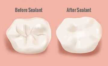 dental-sealant